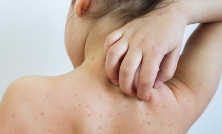 Mjekët paralajmërojnë epidemi të re të fruthit