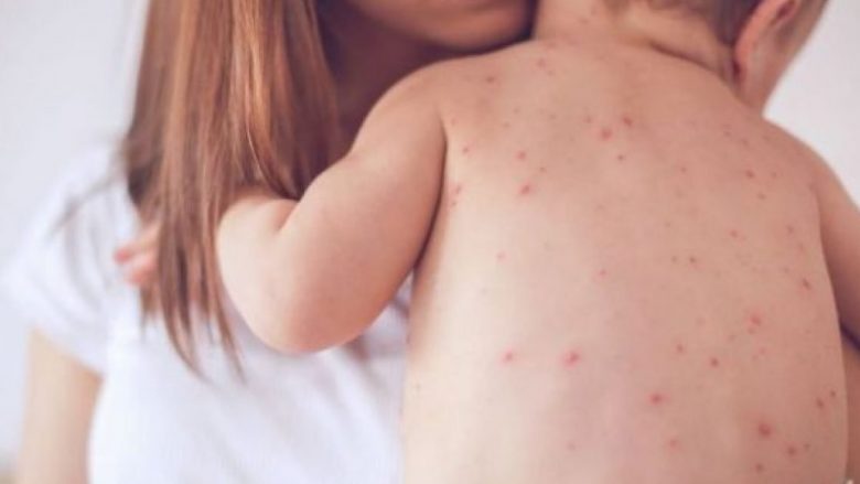 Mjekët  Kujdes  fruthi mund të shpërthejë sërish