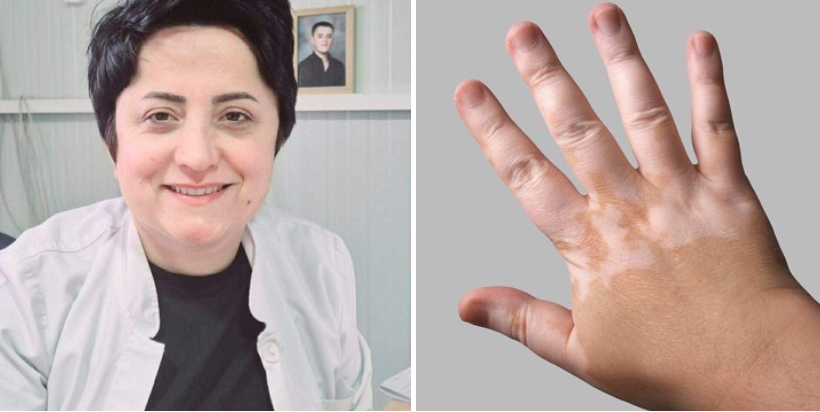 Zbulohet terapia për sëmundjen që konsiderohej e pashërueshme  do e prezanton Dr  Lulije Jahja nga Kërçova